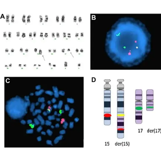 fish - mds panel - chromosome 5q 7q 8q and 20q